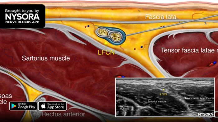 Cpt lateral femoral cutaneous nerve block