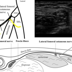 Cpt lateral femoral cutaneous nerve block