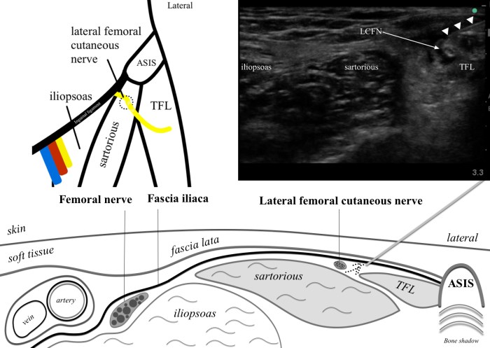 Cpt lateral femoral cutaneous nerve block