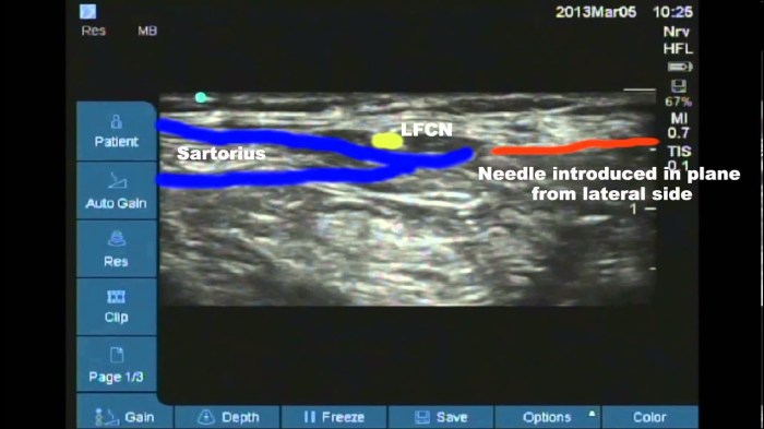 Block nerve cutaneous lateral femoral procedure lfcn