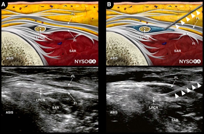 Lateral femoral nerve cutaneous block ultrasound injection aneskey